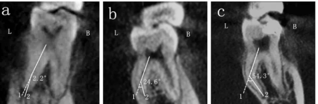 Fig 1. The angle of the DL root canal curvature in the BL orientation. The three pictures displayed curvatures of DL root in the BL orientation of different degrees: a, straight root canal; b, moderately curved root canal and c, severely curved root canal