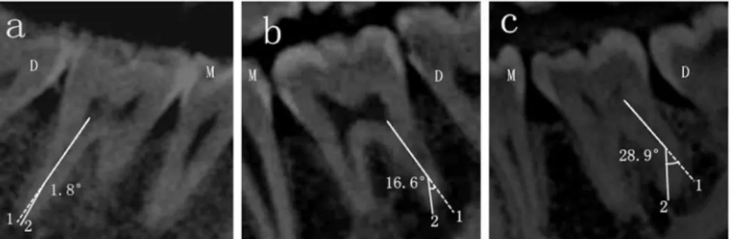 Fig 3 showed the measurement of the angle of DB-DL-ML. Also choosing Panorama imag- imag-ing, in the window of axial (from above) plane, the center points of the DB, DL and ML were labeled in the level of pulp chamber floor.