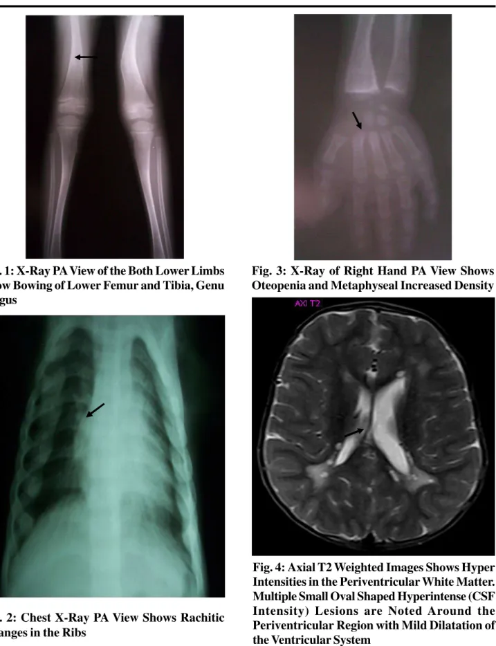 Fig. 3: X-Ray of Right Hand PA View Shows Oteopenia and Metaphyseal Increased DensityFig
