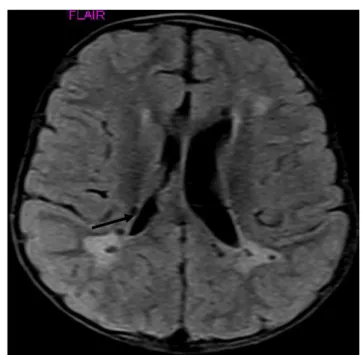 Fig. 7: Axial FLAIR Image Shows Periventri- Periventri-cular Hyper Intensities with Multiple Hypo  In-tense Cystic Lesions