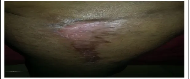 Figura 4 – Cicatrização total de ferida por erisipela bolhosa. 