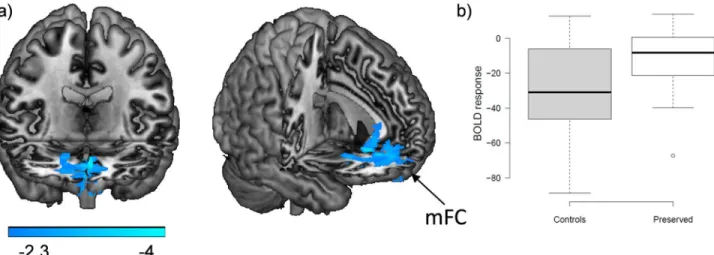 Fig 4. Brain functional changes between controls and cognitively preserved patients. (A) Brain regions where the cognitively preserved patients showed significant failure of de-activation compared with the controls in the 2-back vs