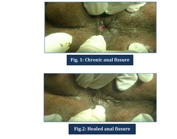 Fig. 1: Chronic anal fissure