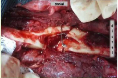 Figura 2: Foto intra operatória da primeira cirurgia, depois do realinhamento do osso  e colocação do pino intramedular e fio de cerclagem