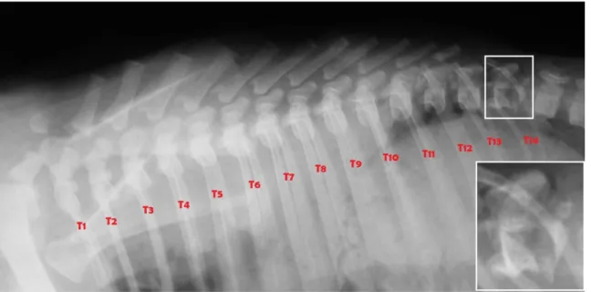 Figura 2 – Imagem radiográfica demonstrando 14 vértebras torácicas e fratura completa  simples de T14