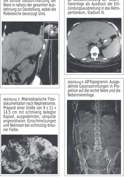 Abbildung 2:  Transversalschnitt in Höhe der Nebennierenlogen.  Rechtsseiti-ge Gasdurchsetzung der  Neben-nierenloge als Ausdruck der  Ent-zündungsausbreitung in das  Retro-peritoneum, Stadium III.
