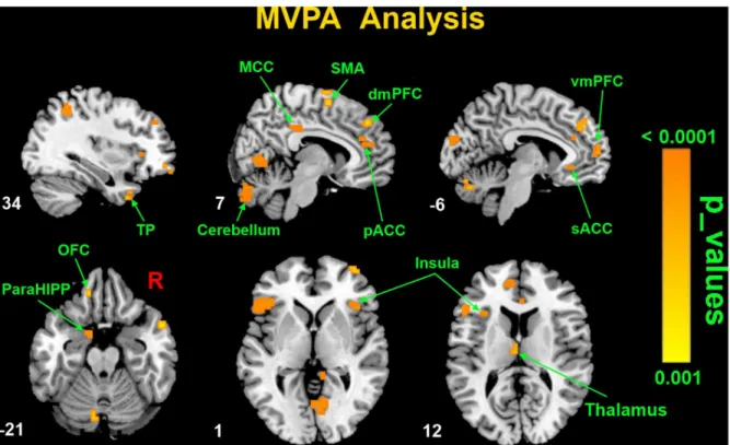 Figure 2. Spatial maps of classifier accuracies for distinguishing a ReHo map between FD patients and healthy controls using the MVPA analysis