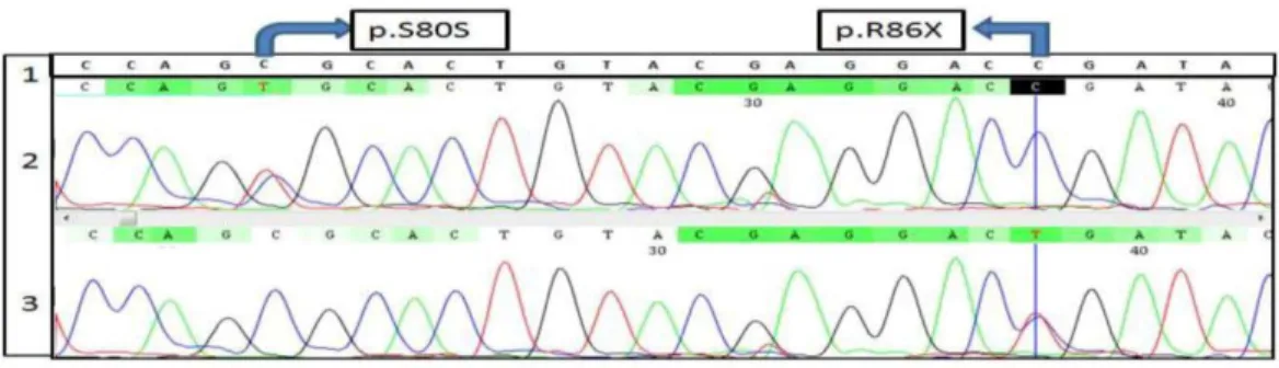 Figure 2. Lane #1 is ASS1 gene coding exon 3-NCB1-reference. Lane #2 is ASS1 gene-coding exon- exon-Normal sample and  lane #3 is ASS1 gene-coding exon 3-Abnormal sample 