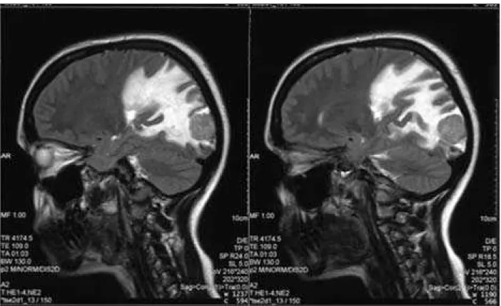 Figure 2. MRI of the endocranium: the subtentorial right herniation of the uncus hyppocampus with compressive effect on the right lateral ventricle  and right cerebral peduncle of the mesencephalon 