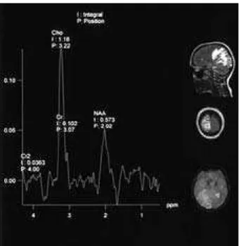 Figure 4. Single voxel MR spectroscopy findings: extreme elevation of  the indexes Cho/Cr, reduction of the NAA and absent Cr2 peak