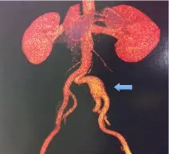 Figura 01:Aneurisma de artéria iliaca comum esquerda - Angiotomografia  Créditos: Dr. Marco Túlio Baccarini Pires