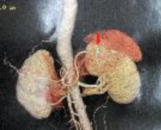 Figura 03:Angiotomografia das artérias do abdômen - Aneurisma da Artéria Esplênica  Créditos: Dr
