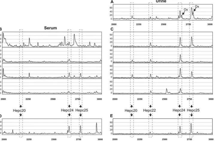 Figure 1. SELDI-TOF MS profiles obtained in the different experiments. SELDI-TOF MS profiles of (A) hepidin-24 spiked urine sample showing next to the expected hepcidin forms also methionine oxidized (Ox) forms of Hepc24 and Hepc25; (B and C) different pat