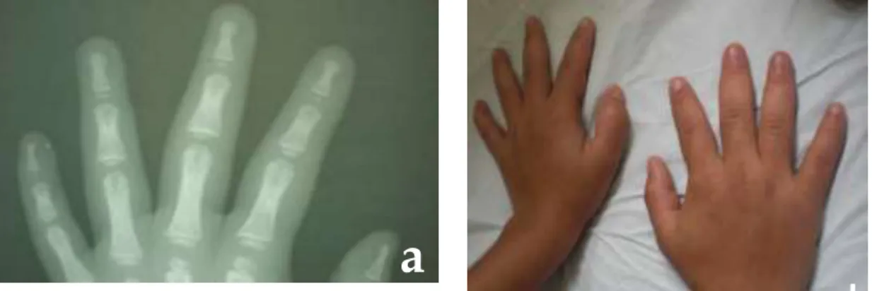 FIGURA 5 – Raio-X das mãos do probando 4 – falanges distais afiladas em aspecto  de  tufo  (a)