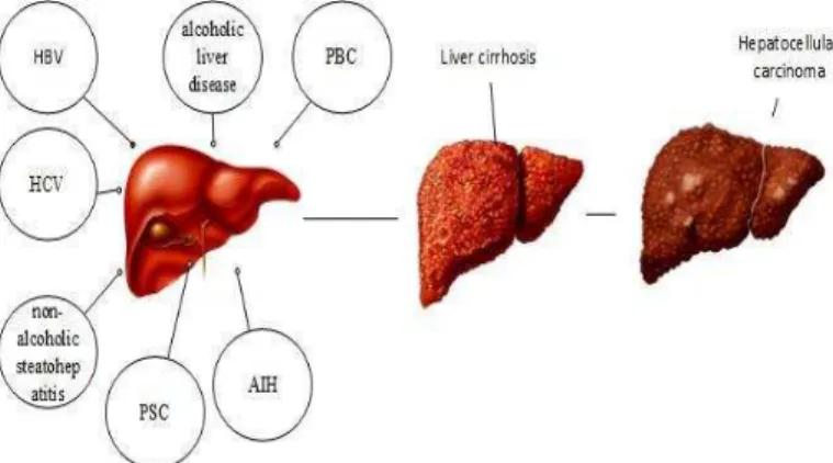 Fig. 1.  The main causes of liver cirrhosis 