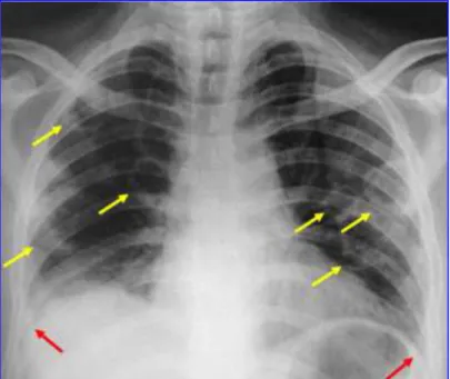 FIGURA 2. Radiografia de tórax em PA no segundo dia de internação. Imagens nodulares,  de  dimensões  variadas,  pelo  menos  6,  de  aspecto  escavado,  esparsas  pelo  parênquima  pulmonar, bilateralmente (setas amarelas)