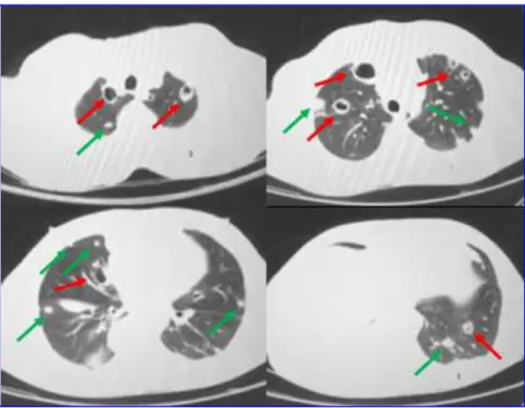 FIGURA 3.  Tomografia computadorizada  de  tórax,  janela  de  pulmão.  Múltiplas  opacidades  nodulares,  as  menores  sólidas  (setas  verdes)  e,  as  maiores,  de  aspecto  escavado  (setas  vermelhas), distribuídas, difusamente,  pelo parênquima pulmo