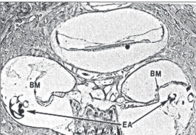 Figure 5. Open cochlear aqueduct [30]