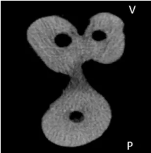 FIGURA 3:  Imagem  microtomográfica do primeiro pré-molar superior demonstrando a  presença dos orifícios de abertura dos dois canais principais em uma linha perpendicular  à linha mésio-distal