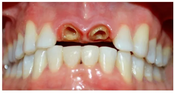 FIGURA  2:  canais  radiculares  com  abertura  ampla  e  desfavorável  para  a  correta  adaptação  dos pinos pré-fabricados de fibra de vidro