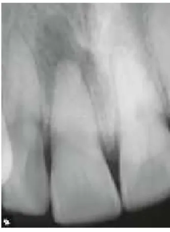 Figura 1: Calficação total do canal radicular do dente 11, com presença de radiolucidez periapical