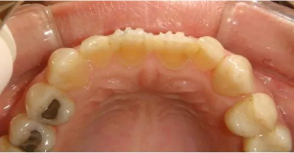 Figura  3.  Vista  palatina  de  incisivos  superiores  apresentando  erosão  dentária  provocada  por  vómitos  durante gestações