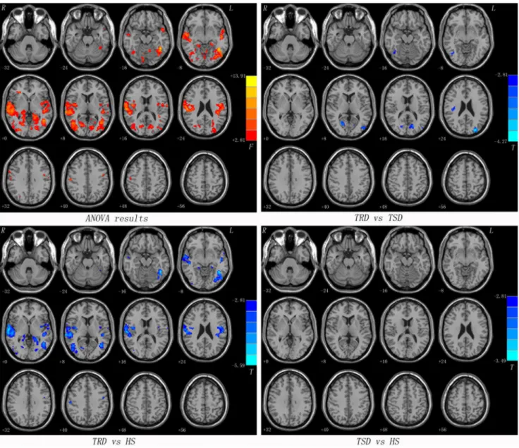 Figure 2. Statistical maps showing seed-based FC differences between subject groups (seed: the left calcarine cortex)