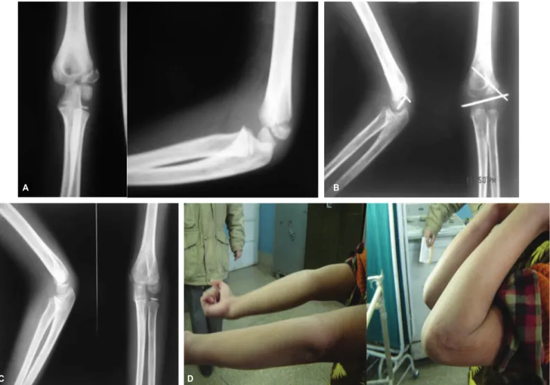 Fig. 1: Showing  the  lateral  condyle  fracture  in  an  8  year  old  boy  [A].  Open  reduction  and  fixation  was  done  after  6  weeks  [B]