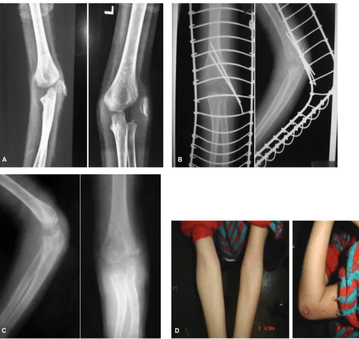 Fig. 3: 8 week old fracture of the lateral condyle [A]. Immediate post operative and final x rays [B and C]