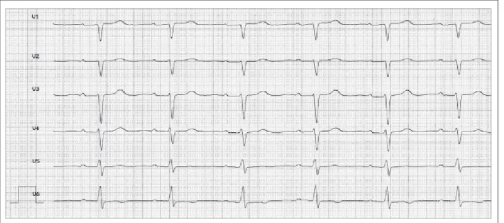 Abbildung 3: Sinusrhythmus nach elektrischer Kardioversion (Frequenz: 78 Schläge/Minute)