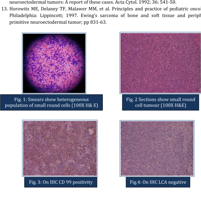 Fig. 2 Sections show small round  cell tumour (100X H&amp;E)
