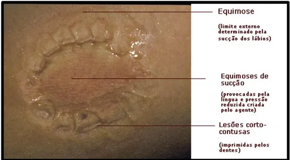 Figura 2. Exemplo de uma marca de mordida humana (Fonte: Odontologia Legal  USP, 2015)