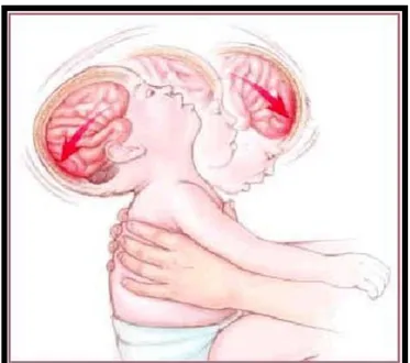 Figura  12.Movimento  do  cérebro  causado  pelo  Síndrome  de  “Shaken  baby”  (Fonte:  Brain  Injury  Group Foundation, 2015)