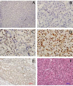 Figure 1. Expressions of HMGB1 in HCC tissues and surround- surround-ing non-cancerous tissues