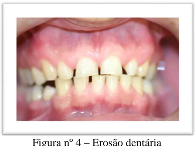 Figura nº 4 – Erosão dentária  