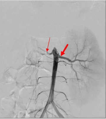 Fig. 1. Very little illing or full stenosis of the right renal artery on the renal arterio- arterio-graph (thin arrow) and normal illing of the let renal artery (bold arrow) 