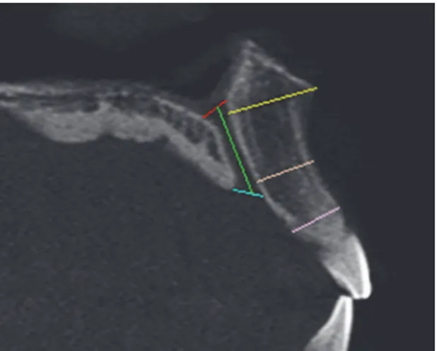 Fig 2. Measurement of the incisive canal length (green line) and anterior maxillary bone thickness at 3 levels (yellow, orange &amp; pink lines).