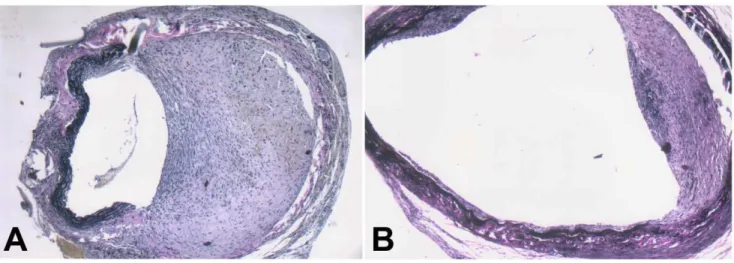 Figure 7. Nanoparticle-mediated delivery of a TGF-b1 antisense-expressing construct inhibits intimal hyperplasia in grafted veins.
