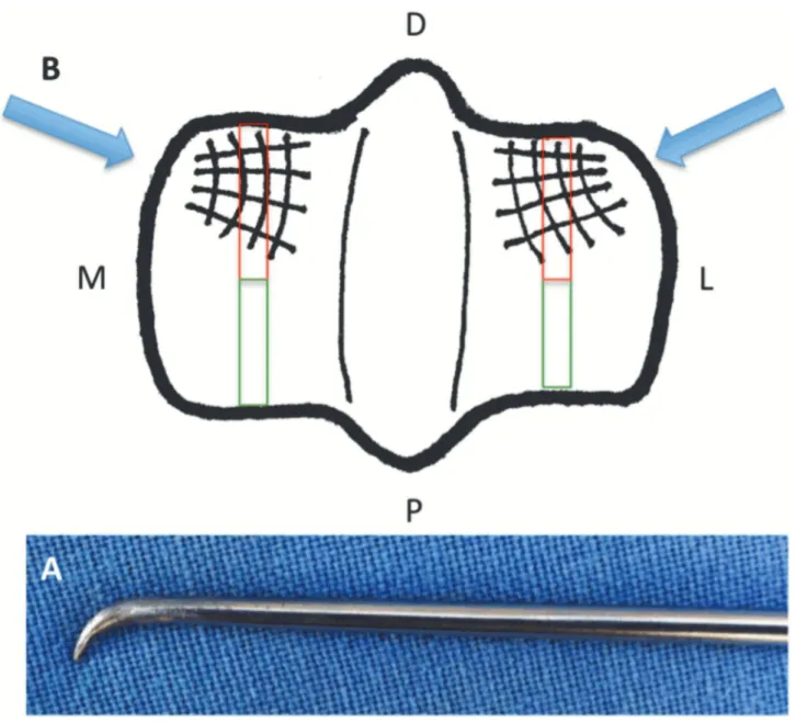 Figure 1. (A) Modified arthroscopic probe in which the tip was hooked and sharpened to a 2 mm internal length