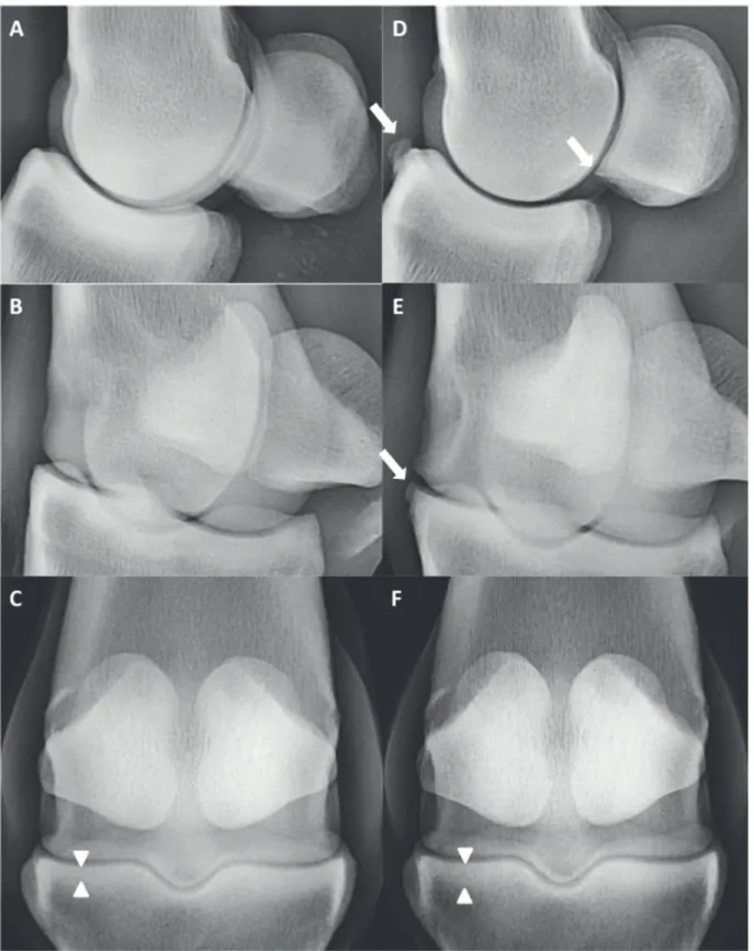 Figure 3. Radiographic views of the MP joint of an individual at week 0 (A, B, C) and week 10 (D, E, F)