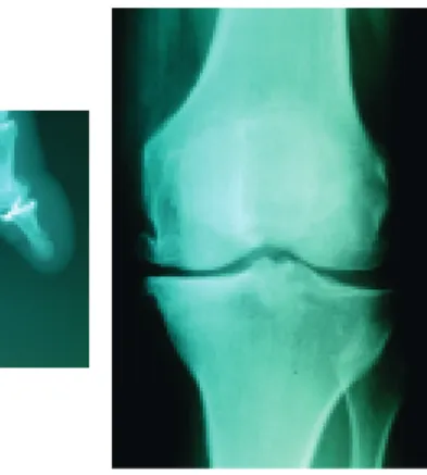 Figura 1 - Aspectos radiológicos típicos da osteoartrose (vd texto para explicações)