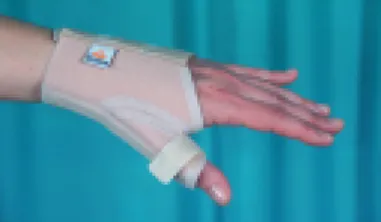 Figura 2 - Tala de imobilização do polegar: indicada para alívio sintomático e protecção articular na rizartrose e na tendinite de De Quervain