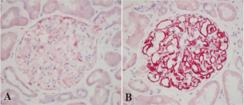 Fig 2. Immunohistochemical staining of PLA2R in glomerular deposits (ALP ×400). (A) In patients with minimal change disease there is very weak expression of PLA2R on the glomerular potocytes and it is recognized as negative result in this study