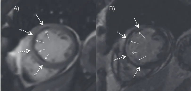 Fig 6. Comparison between MO on early cine SSFP and LGE. A) Cine imaging performed 4 minutes after contrast medium injection