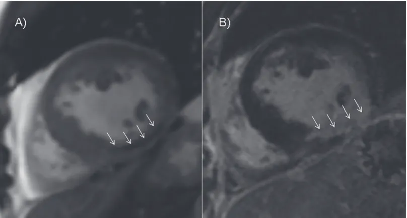 Fig 7. Comparison between MO on early cine SSFP and LGE. A) Cine imaging performed 4 minutes after contrast medium injection