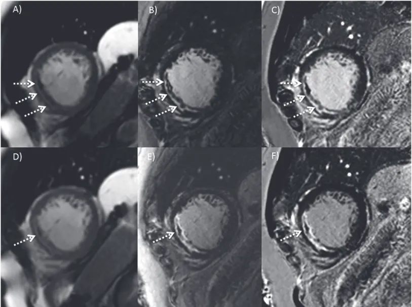 Fig 8. MO with different imaging methods. Early enhancement 9 min after contrast agent: A) Cine SSFP B) IR GE imaging and C) PSIR