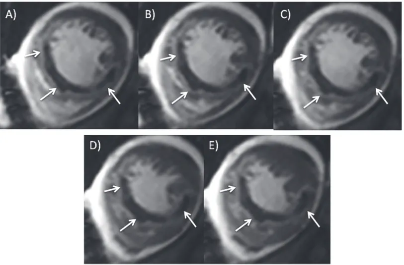 Fig 1. Typical MO appearance on early cine SSFP imaging at the same slice position during the cardiac cycle (A-E).