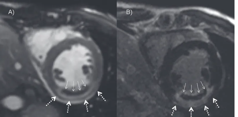 Fig 4. Cine and LGE imaging after 6 and 14.5 minutes respectively. Both images (A and B) show a well demarcated hyperintense midventricular inferolateral myocardium with a subendocardial located crescent shaped hypointensity representing myocardial infarct