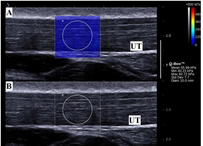 Figure 4. Measurement of elasticity of the upper trapezius muscle (UT) in longitudinal view