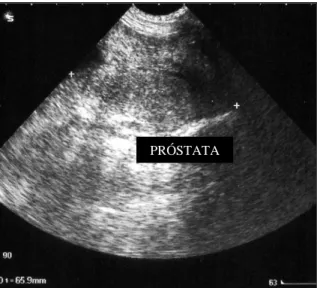 Figura 6 – Hiperplasia benigna da próstata. 